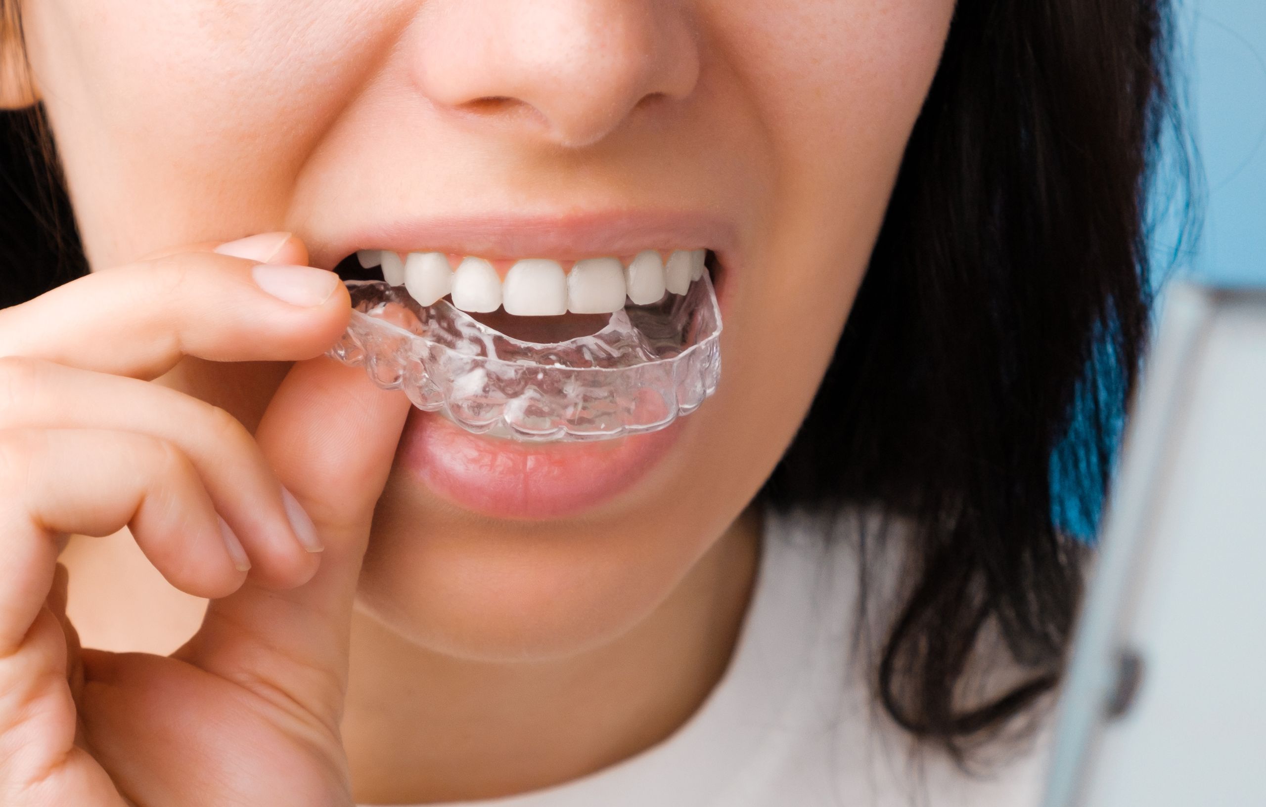 woman putting in an invisalign retainer